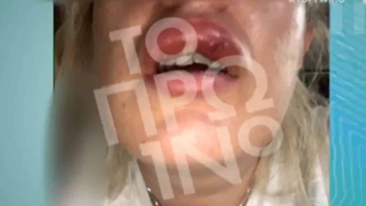 Σοκάρουν οι φωτογραφίες της 38χρονης γυναίκας που καταγγέλλει γνωστό πλαστικό χειρουργό για παραμόρφωση